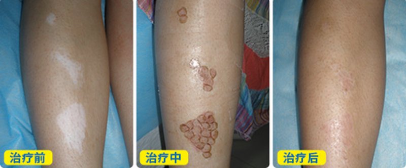 阜阳治疗白癜风医院：探寻最佳治疗方案